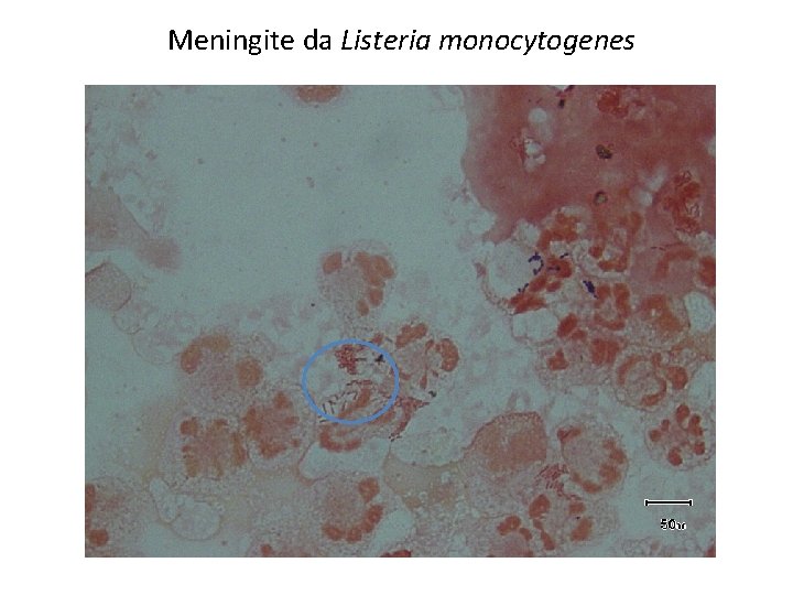 Meningite da Listeria monocytogenes 