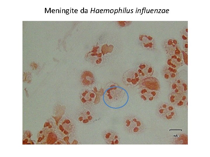 Meningite da Haemophilus influenzae 