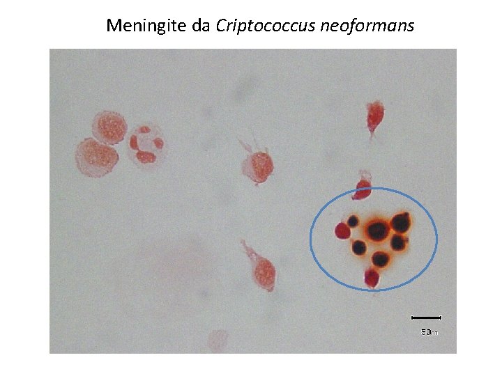 Meningite da Criptococcus neoformans 