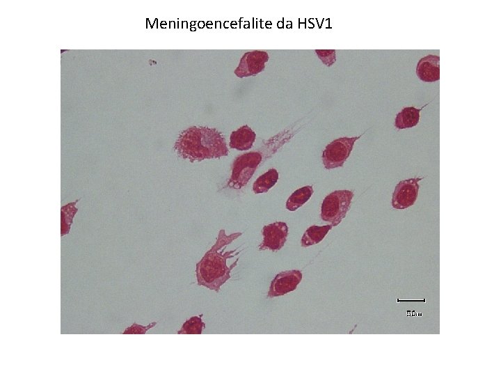 Meningoencefalite da HSV 1 