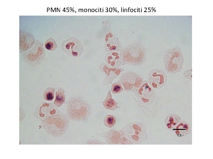 PMN 45%, monociti 30%, linfociti 25% 