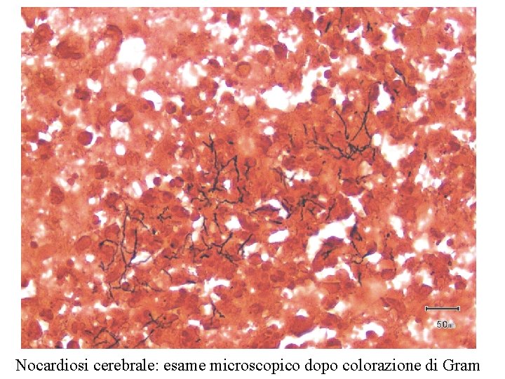 Nocardiosi cerebrale: esame microscopico dopo colorazione di Gram 