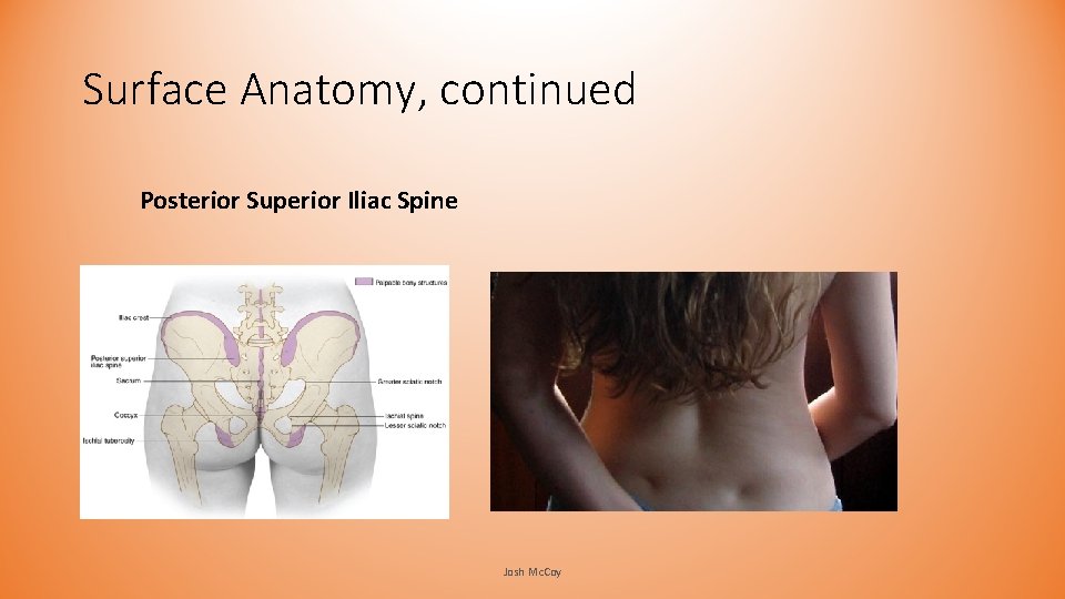 Surface Anatomy, continued Posterior Superior Iliac Spine Josh Mc. Coy Surface Anatomy, continued Posterior Superior Iliac Spine Josh Mc. Coy