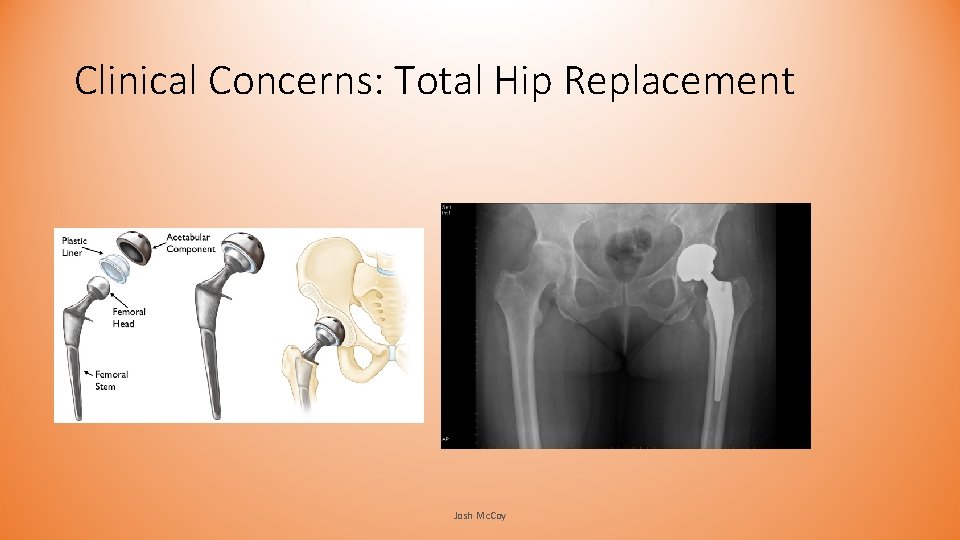 Clinical Concerns: Total Hip Replacement Josh Mc. Coy Clinical Concerns: Total Hip Replacement Josh Mc. Coy