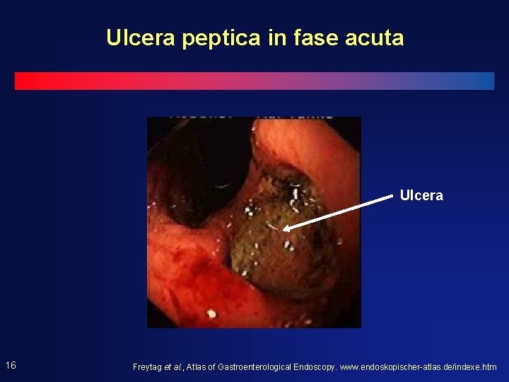Ulcera peptica in fase acuta Ulcera 16 Freytag et al. , Atlas of Gastroenterological Ulcera peptica in fase acuta Ulcera 16 Freytag et al. , Atlas of Gastroenterological