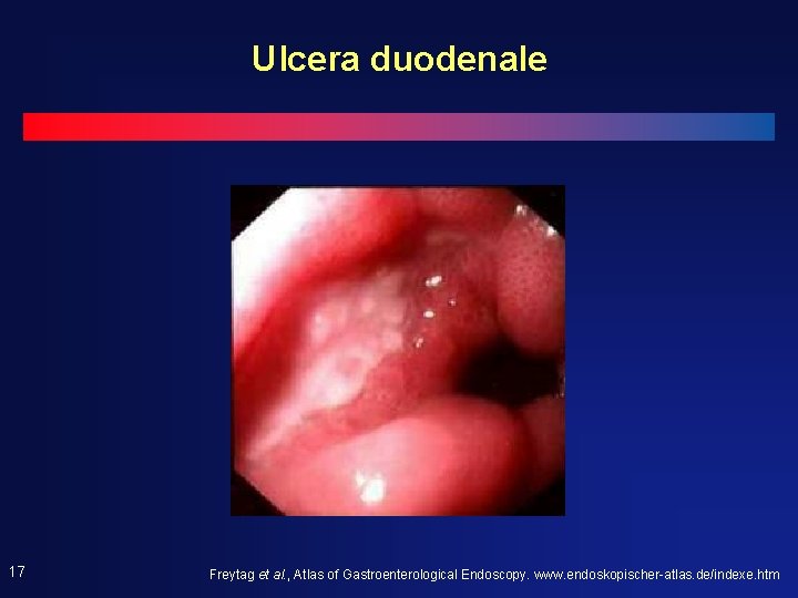 Ulcera duodenale 17 Freytag et al. , Atlas of Gastroenterological Endoscopy. www. endoskopischer-atlas. de/indexe. Ulcera duodenale 17 Freytag et al. , Atlas of Gastroenterological Endoscopy. www. endoskopischer-atlas. de/indexe.