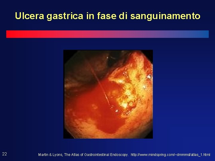 Ulcera gastrica in fase di sanguinamento 22 Martin & Lyons, The Atlas of Gastrointestinal Ulcera gastrica in fase di sanguinamento 22 Martin & Lyons, The Atlas of Gastrointestinal