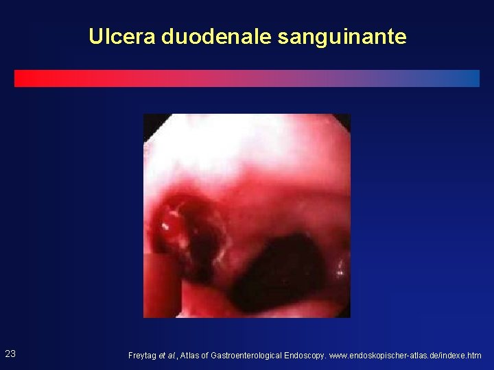 Ulcera duodenale sanguinante 23 Freytag et al. , Atlas of Gastroenterological Endoscopy. www. endoskopischer-atlas. Ulcera duodenale sanguinante 23 Freytag et al. , Atlas of Gastroenterological Endoscopy. www. endoskopischer-atlas.