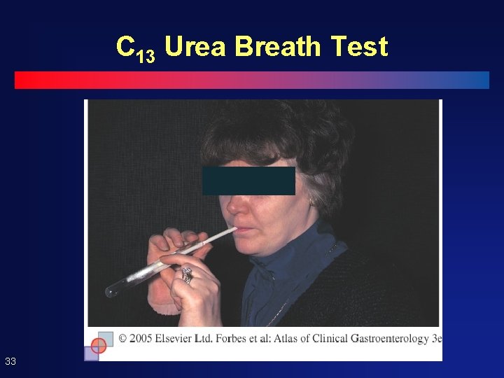 C 13 Urea Breath Test 33 C 13 Urea Breath Test 33