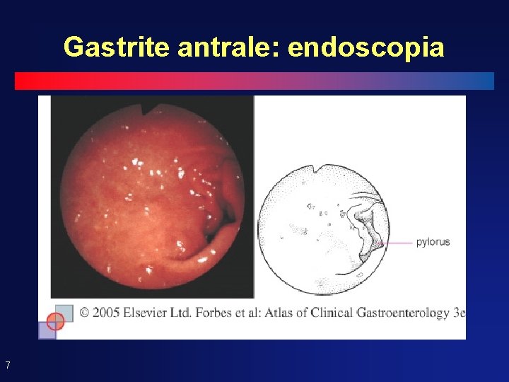 Gastrite antrale: endoscopia 7 Gastrite antrale: endoscopia 7