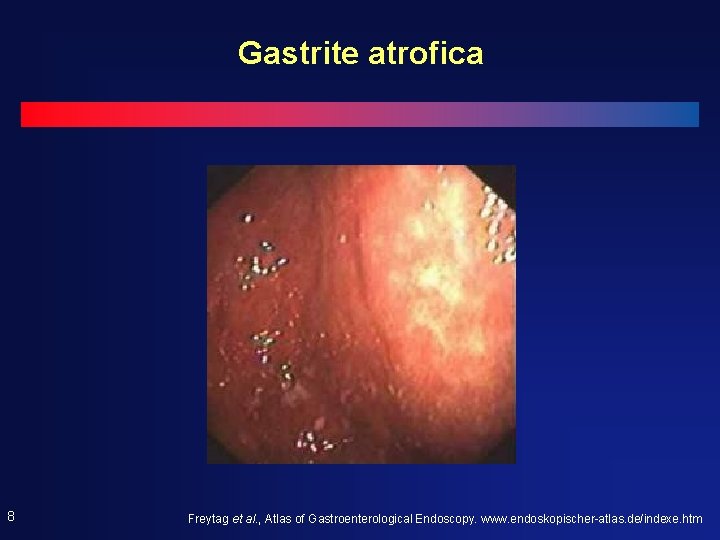 Gastrite atrofica 8 Freytag et al. , Atlas of Gastroenterological Endoscopy. www. endoskopischer-atlas. de/indexe. Gastrite atrofica 8 Freytag et al. , Atlas of Gastroenterological Endoscopy. www. endoskopischer-atlas. de/indexe.