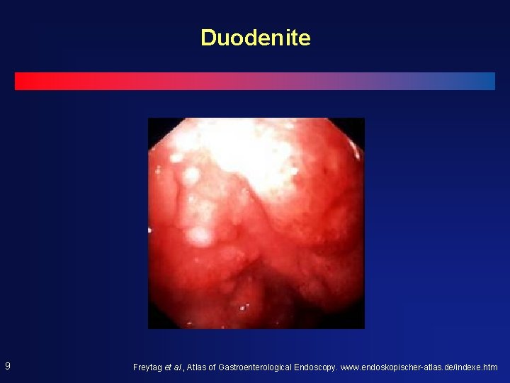 Duodenite 9 Freytag et al. , Atlas of Gastroenterological Endoscopy. www. endoskopischer-atlas. de/indexe. htm Duodenite 9 Freytag et al. , Atlas of Gastroenterological Endoscopy. www. endoskopischer-atlas. de/indexe. htm