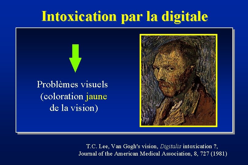 Intoxication par la digitale Problèmes visuels (coloration jaune de la vision) T. C. Lee,