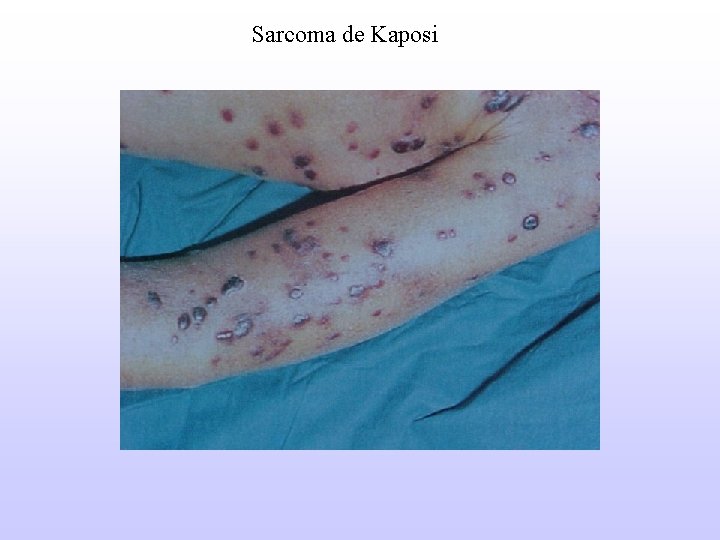 Sarcoma de Kaposi 