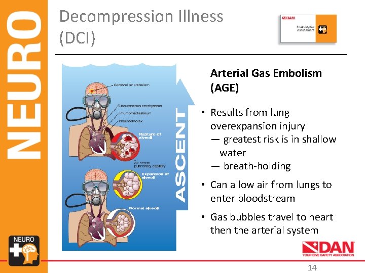 Decompression Illness (DCI) Arterial Gas Embolism (AGE) • Results from lung overexpansion injury —