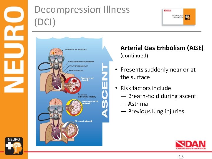 Decompression Illness (DCI) Arterial Gas Embolism (AGE) (continued) • Presents suddenly near or at