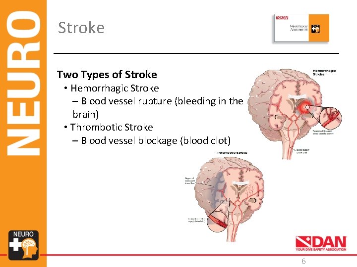 Stroke Two Types of Stroke • Hemorrhagic Stroke – Blood vessel rupture (bleeding in