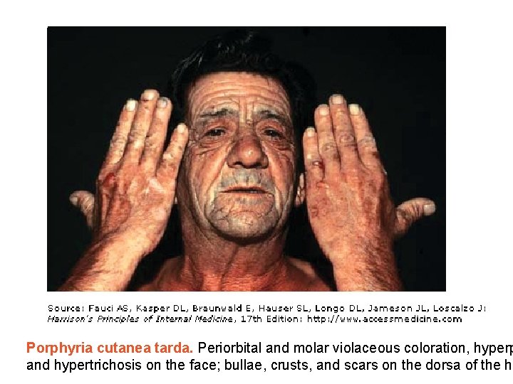 Porphyria cutanea tarda. Periorbital and molar violaceous coloration, hyperp and hypertrichosis on the face;