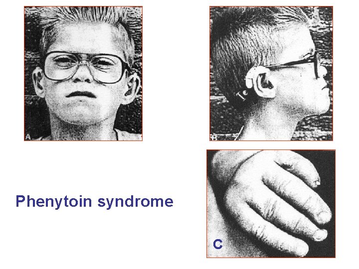 Phenytoin syndrome С 