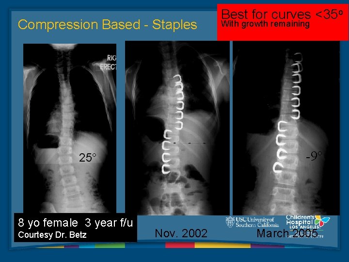 Compression Based - Staples Best for curves <35 o With growth remaining 5° 25°