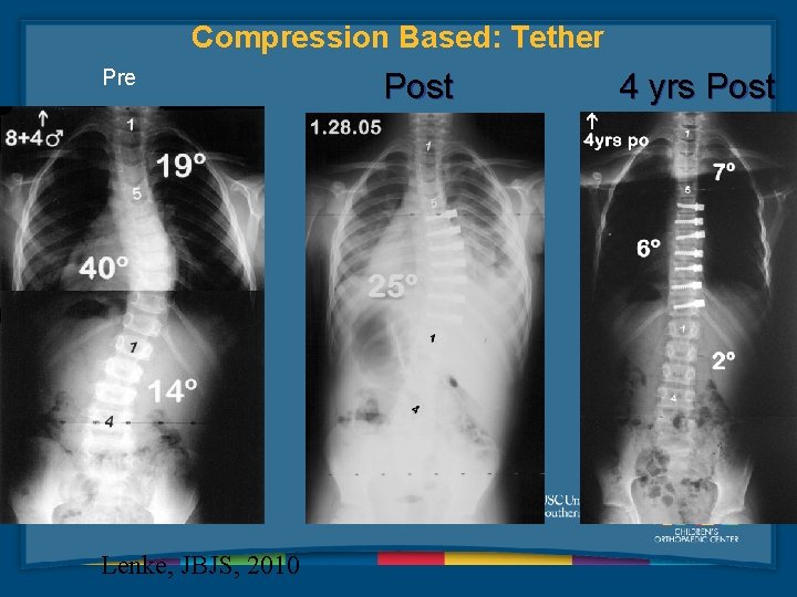 Compression Based: Tether Pre Lenke, JBJS, 2010 Post 4 yrs Post 