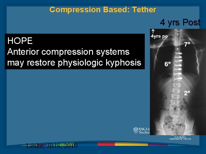 Compression Based: Tether 4 yrs Post HOPE Anterior compression systems may restore physiologic kyphosis