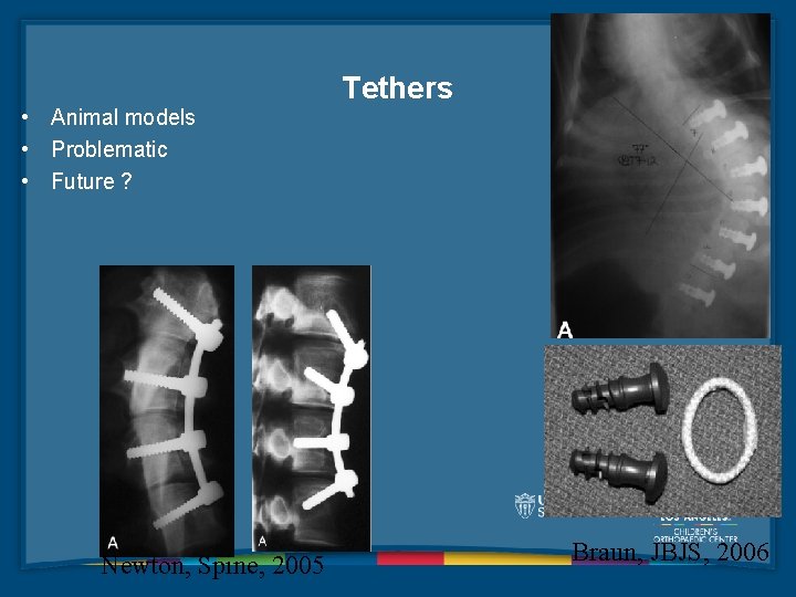  • Animal models • Problematic • Future ? Newton, Spine, 2005 Tethers Braun,