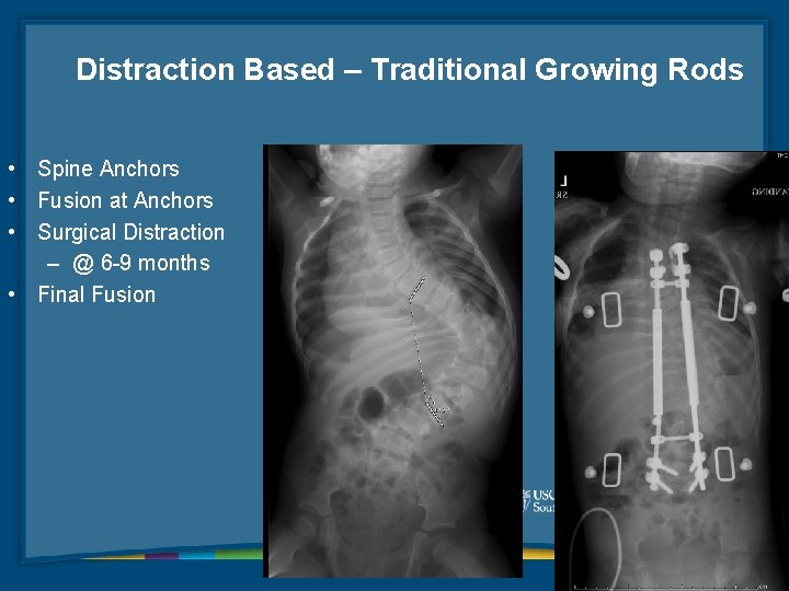 Distraction Based – Traditional Growing Rods • Spine Anchors • Fusion at Anchors •