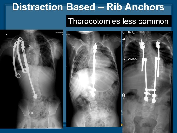 Distraction Based – Rib Anchors Thorocotomies less common 