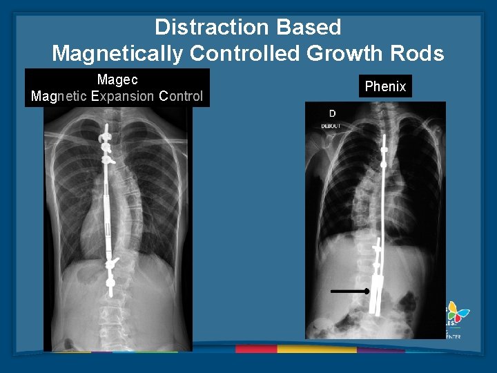 Distraction Based Magnetically Controlled Growth Rods Magec Magnetic Expansion Control Phenix 