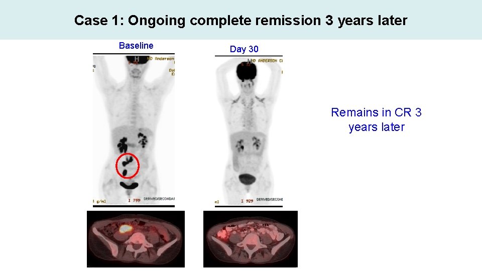 Case 1: Ongoing complete remission 3 years later Baseline Day 30 Remains in CR