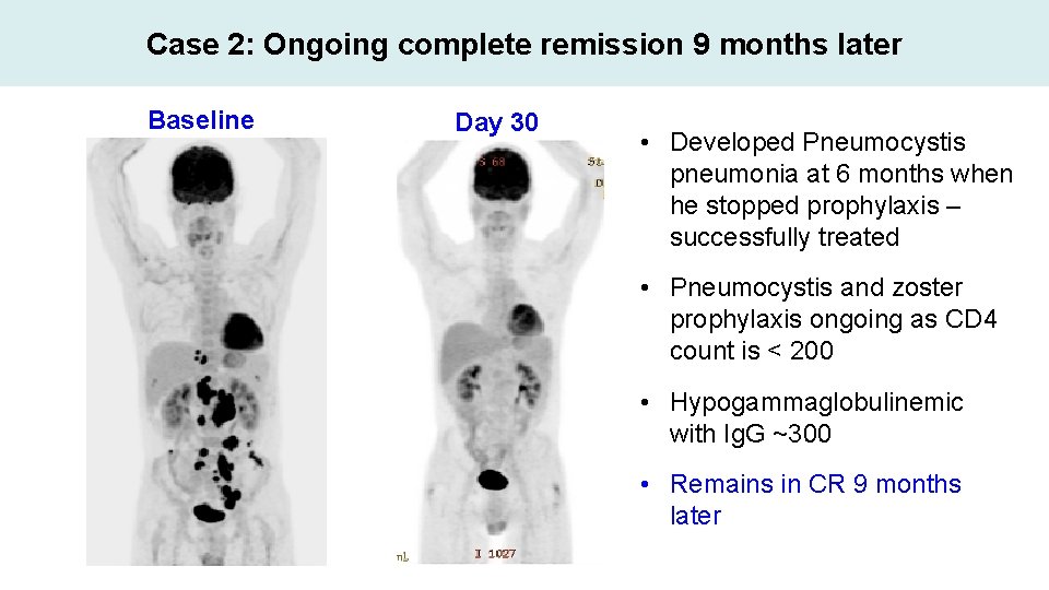 Case 2: Ongoing complete remission 9 months later Baseline Day 30 • Developed Pneumocystis