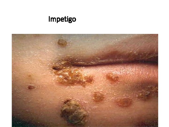 Impetigo 