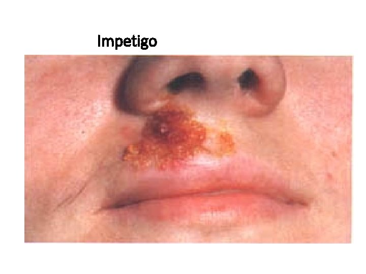 Impetigo 