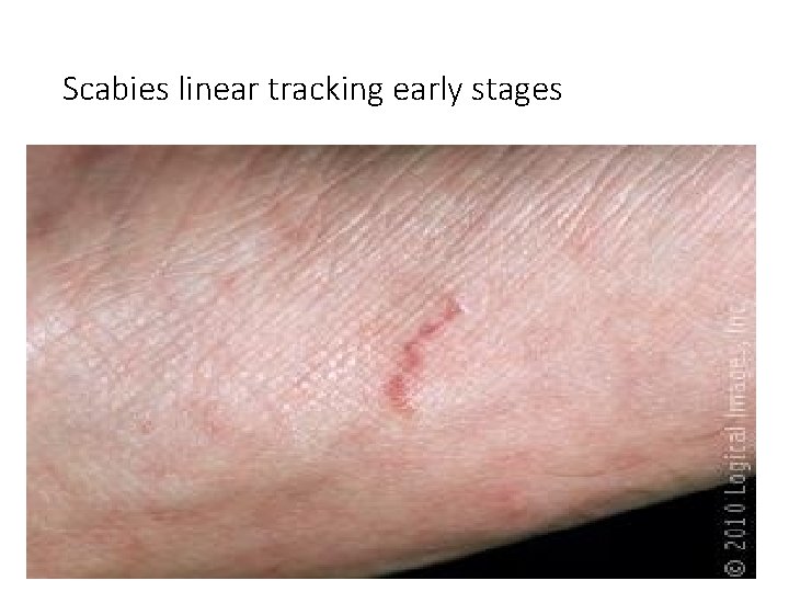 Scabies linear tracking early stages 