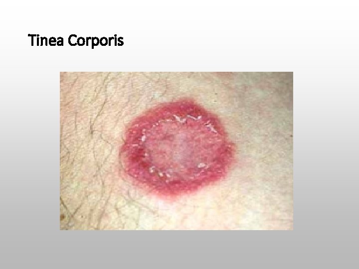 Tinea Corporis 