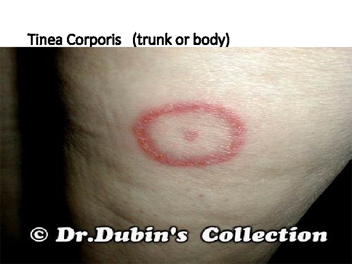 Tinea Corporis (trunk or body) 