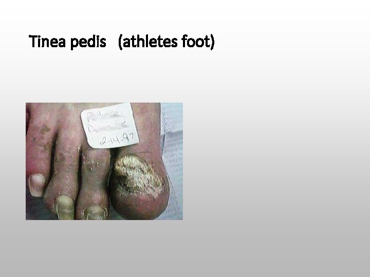 Tinea pedis (athletes foot) 