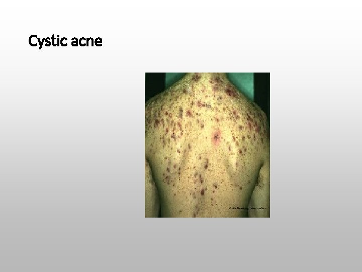 Cystic acne 