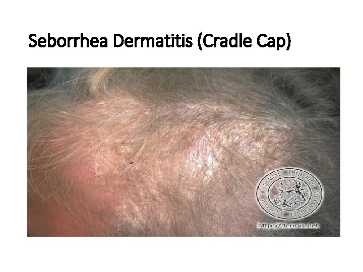 Seborrhea Dermatitis (Cradle Cap) 
