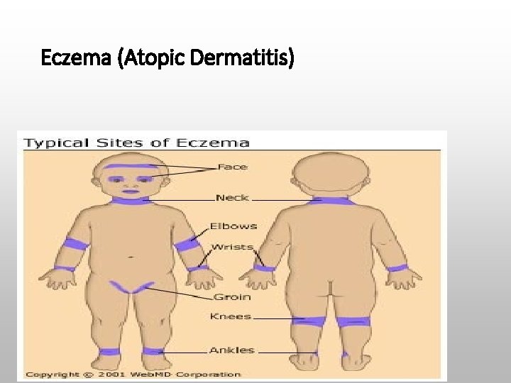 Eczema (Atopic Dermatitis) 