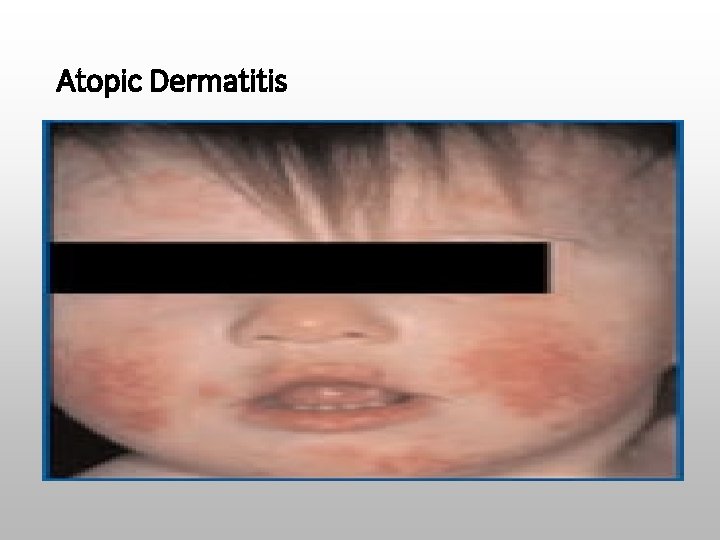 Atopic Dermatitis 