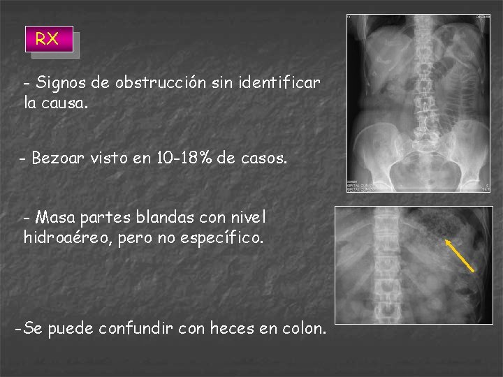 RX - Signos de obstrucción sin identificar la causa. - Bezoar visto en 10