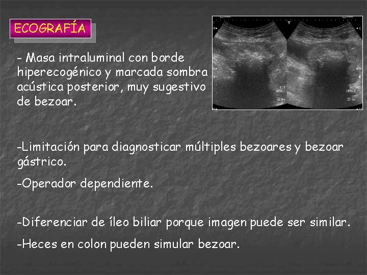 ECOGRAFÍA - Masa intraluminal con borde hiperecogénico y marcada sombra acústica posterior, muy sugestivo