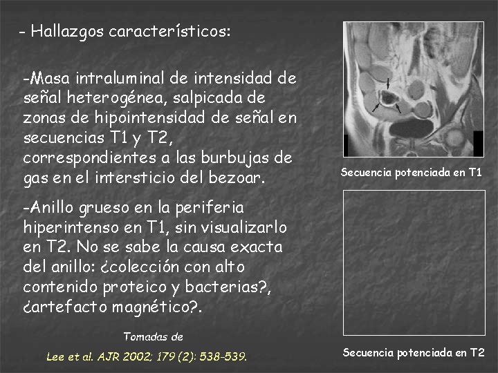 - Hallazgos característicos: -Masa intraluminal de intensidad de señal heterogénea, salpicada de zonas de