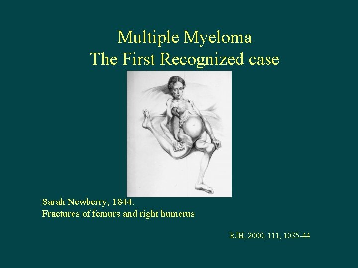 Multiple Myeloma The First Recognized case Sarah Newberry, 1844. Fractures of femurs and right