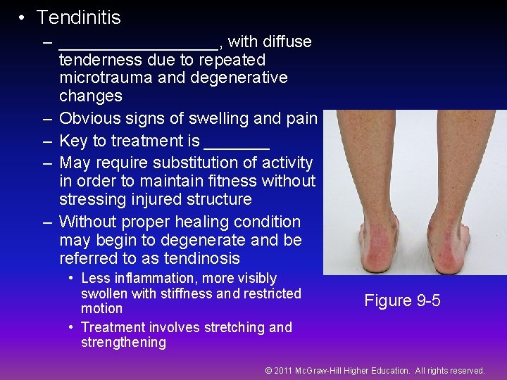  • Tendinitis – _________, with diffuse tenderness due to repeated microtrauma and degenerative
