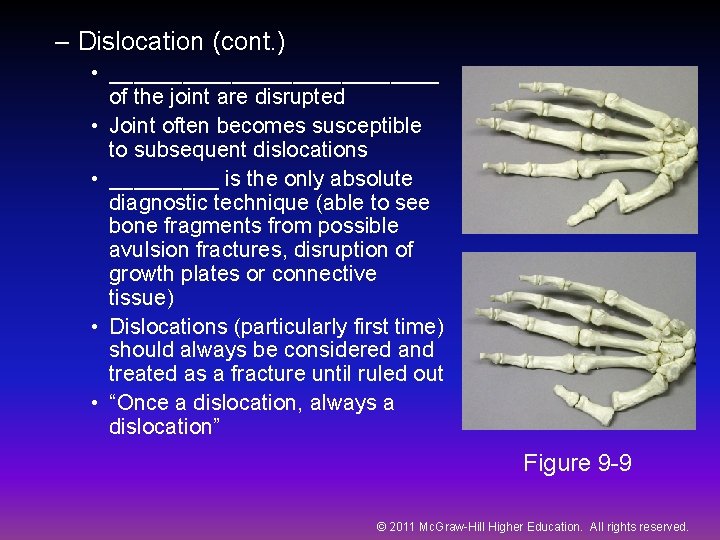 – Dislocation (cont. ) • ______________ of the joint are disrupted • Joint often