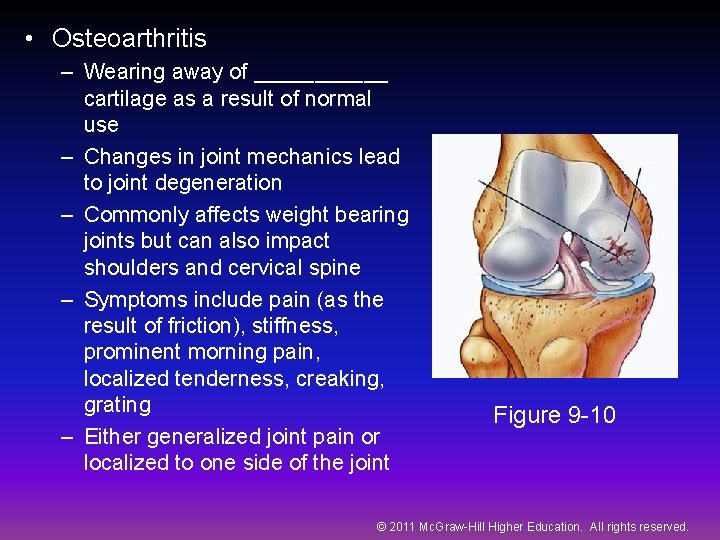  • Osteoarthritis – Wearing away of ______ cartilage as a result of normal