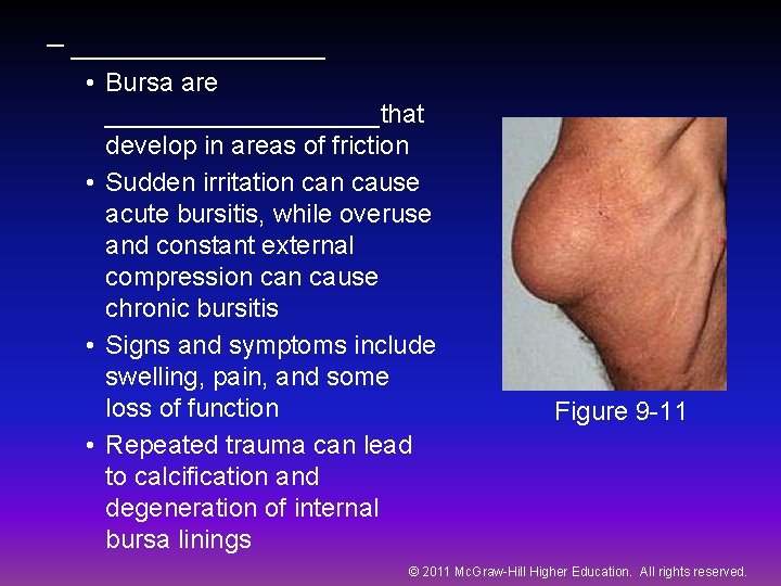 – ________ • Bursa are __________that develop in areas of friction • Sudden irritation